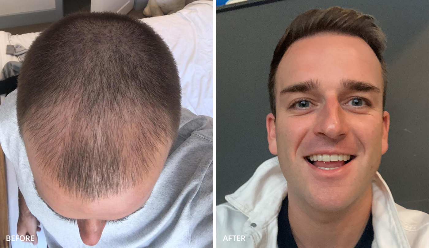 Hair transplant uk